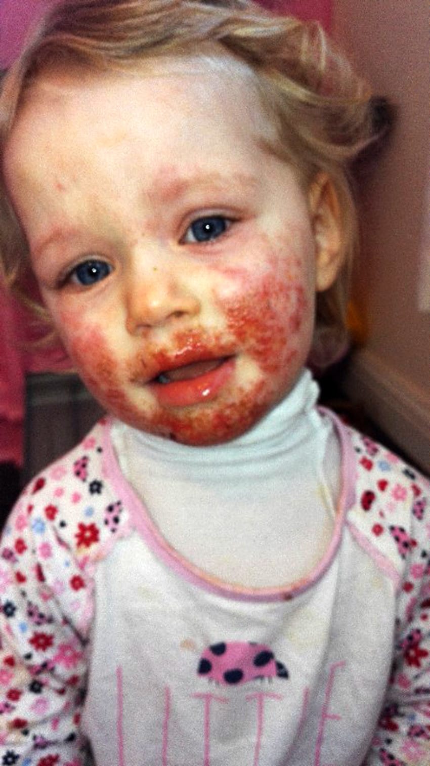 CHILD WITH HERPES ON FACE