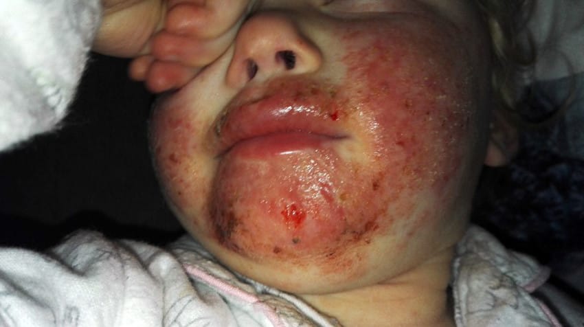 CHILD WITH HERPES ON FACE