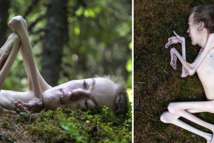 挪威男子患病「受到只剩骨頭」，勇敢拍下「大自然裸體寫真」證明外貌不是一切！